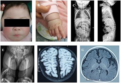 Case Report: Mucolipidosis II and III Alpha/Beta Caused by Pathogenic Variants in the GNPTAB Gene (Mucolipidosis)